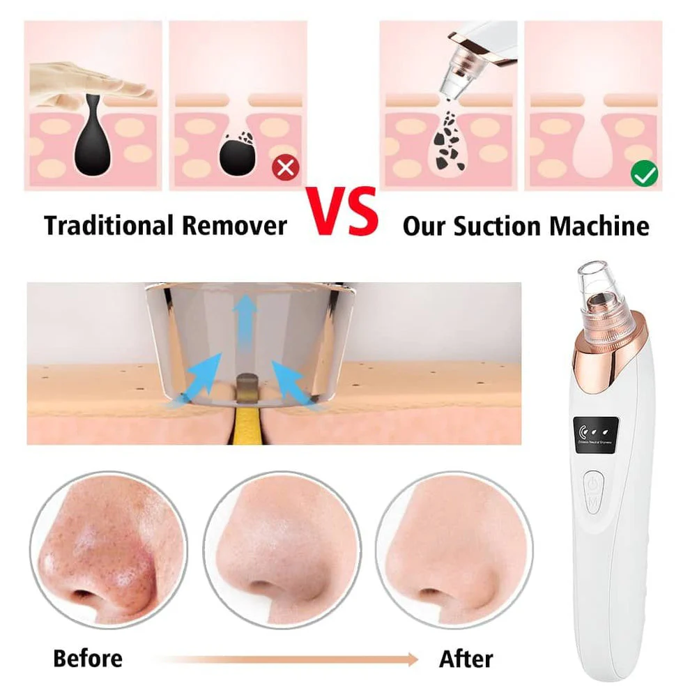 5 in 1 Rechargeable Blackhead Remover Facial Pore Cleaner Deep Cleaning